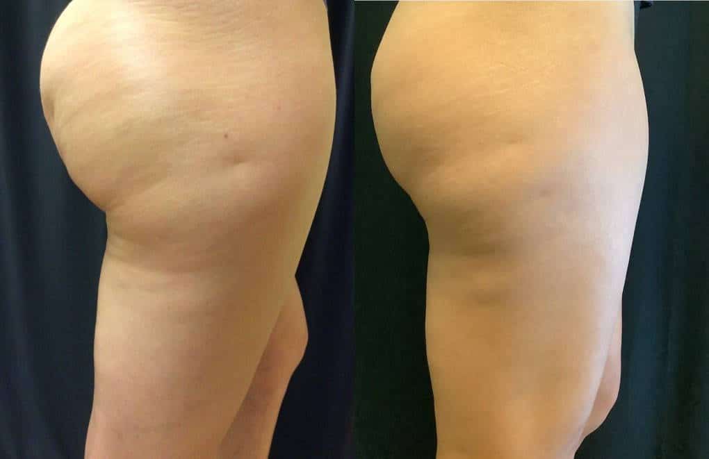 Lake Mary FL Cellulite Reduction Treatments